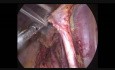 Linfadenectomía pélvica durante una histerectomía radical de Wertheim