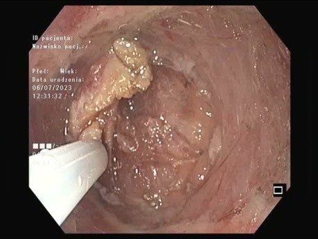 Adenoma gástrico plano - Resección