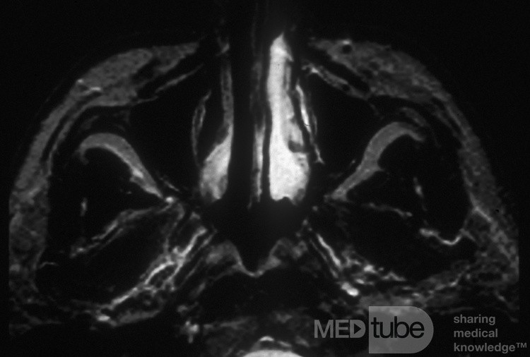 El ciclo nasal normal