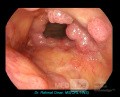 Papilomatosis laríngea recurrente