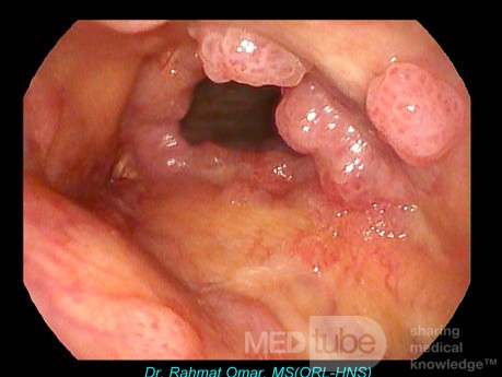 Papilomatosis laríngea recurrente