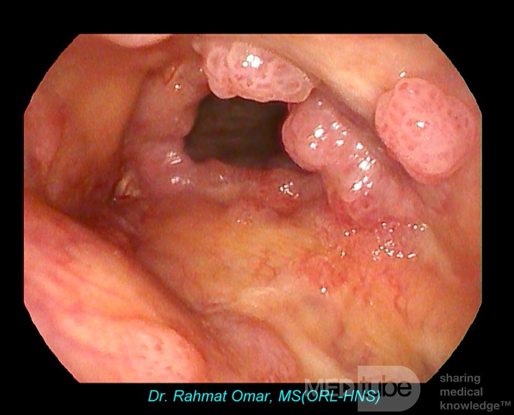 Papilomatosis laríngea recurrente