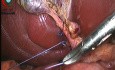 Control del conducto quístico con ligadura con sutura