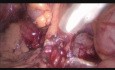 Hemicolectomía izquierda asistida por laparoscopia extendida a la pared abdominal y al tejido graso renal para el cáncer localmente avanzado del colon descendente