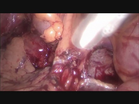 Hemicolectomía izquierda asistida por laparoscopia extendida a la pared abdominal y al tejido graso renal para el cáncer localmente avanzado del colon descendente