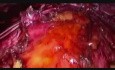 Reparación laparoscópica E-Tep Rives Stoppa con TAR (liberación del músculo transverso del abdomen) derecho