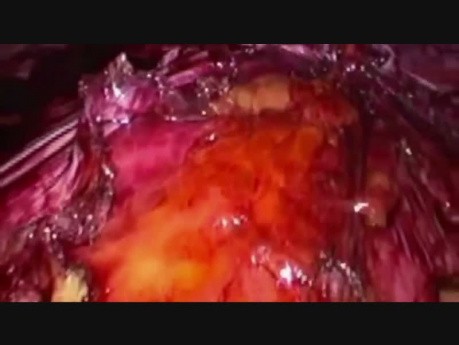 Reparación laparoscópica E-Tep Rives Stoppa con TAR (liberación del músculo transverso del abdomen) derecho