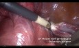 Histerectomía con adherencias vasculares omentales