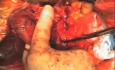 Pancreaticoduodenectomía