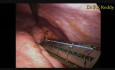 Extracción laparoscópica de un quiste de las vías biliares con colocación de una hepatoyeyunostomía