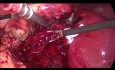 Colecistectomía laparoscópica para colecistitis. Manejo del sangrado del lecho de la vesícula biliar