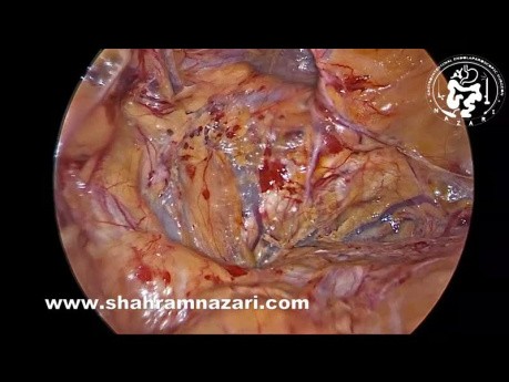 Reparación de hernia inguinal recurrente izquierda