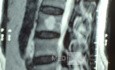 Hemangioma 