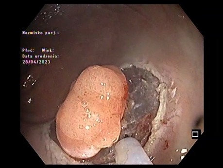 Disección submucosa endoscópica (ESD) rectal de una lesión pequeña sin problemas 