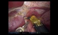 Hepatectomía izquierda robótica y resección caudado parcial