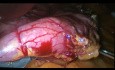 Cómo realizar una gastrectomía sleeve (en manga) laparoscópica