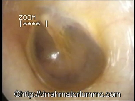 Otoendoscopia: Aspecto del tímpano normal