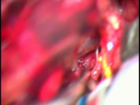 Clipaje de un aneurisma de la arteria basilar