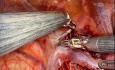 Técnica de reconstrucción robótica con colgajo ácigo para cirugía cardiotorácica multipropósito