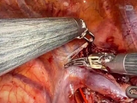 Técnica de reconstrucción robótica con colgajo ácigo para cirugía cardiotorácica multipropósito
