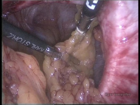 Reparación de hernia paraestomal - abordaje laparoscópico Sugarbaker