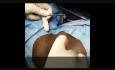 Reconstrucción del esfínter anal - esfinteroplastia