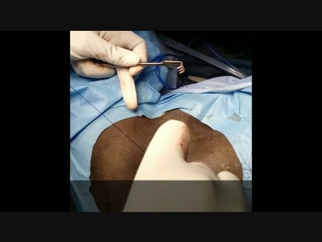 Reconstrucción del esfínter anal - esfinteroplastia