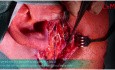 Osteosíntesis de la fractura de la base del cóndilo mandibular