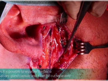 Osteosíntesis de la fractura de la base del cóndilo mandibular