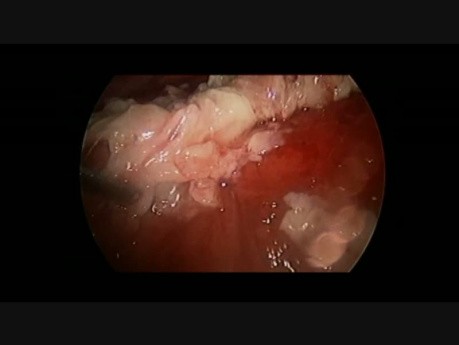 Toracoscopia en el tratamiento del empiema pleural en niña de 2,5 años