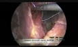 Funduplicatura laparoscópica de Nissen en el tratamiento de ERGE