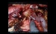 Whipple robótico (AHPBA 2019)