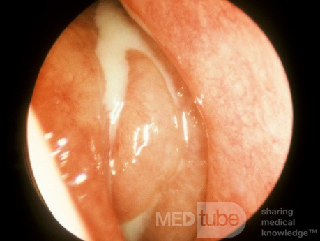 Sinusitis etmoide crónica