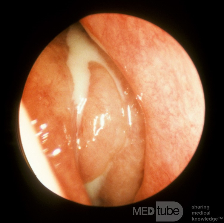 Sinusitis etmoide crónica