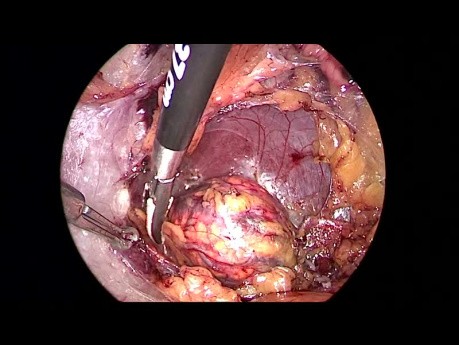 Suprarrenalectomía laparoscópica retroperitoneal (síndrome de Conn)