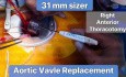 Aortic Valve Size 31mm 