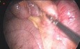 Dolor resistente y patología postapendicectomía