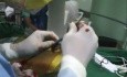 Nefrolitotomía percutánea: eliminación de cálculos renales
