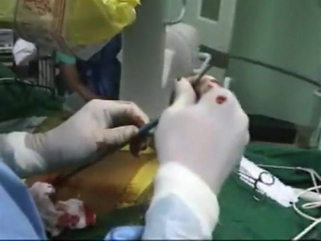 Nefrolitotomía percutánea: eliminación de cálculos renales