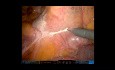 Resección robótica de colon sigmoide para el cáncer