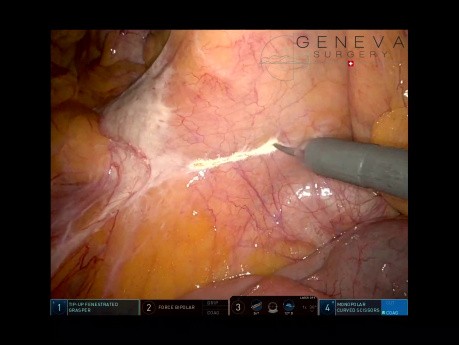 Resección robótica de colon sigmoide para el cáncer