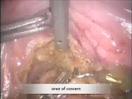 Ventaja de la escisión mesorrectal total robótica en el cáncer de recto avanzado