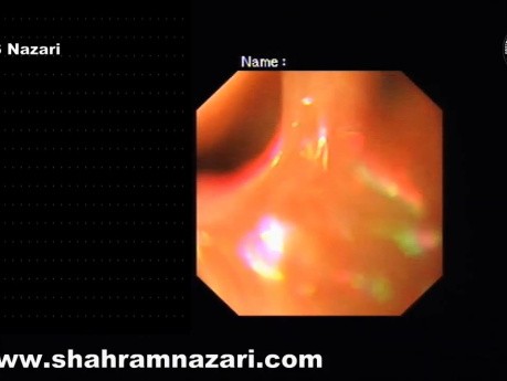 Indicadores endoscópicos de acalasia esofágica