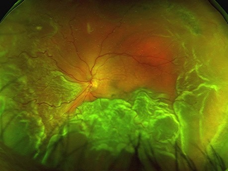 Eliminación de aceite de silicona a través de la cámara anterior en combinación con implante secundario de lentes bifocales