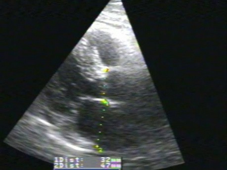 Caso de ecocardiograma de amiloidosis cardíaca