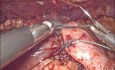 Cirugía antirreflujo para la ERGE - fundoplicatura de Nissen