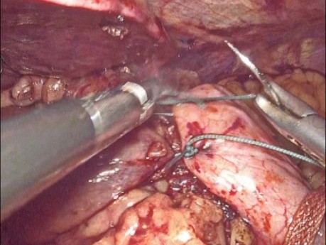 Cirugía antirreflujo para la ERGE - fundoplicatura de Nissen