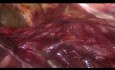 Tratamiento laparoscópico de hernias inguinales y femorales