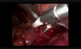Adrenalectomía derecha - técnica minilaparoscópica hibrida transabdominal sin clip