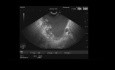 Ultrasonido endoscópico de necrosis pancreática